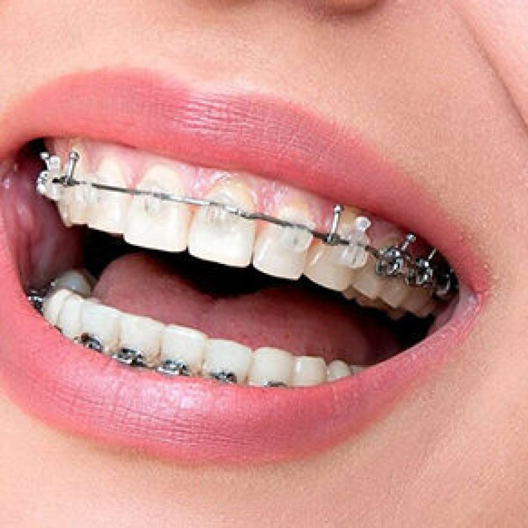 braces-for-crooked-teeth