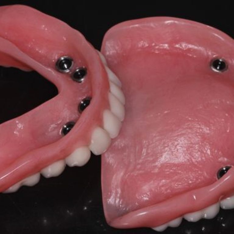 denture-implants-img