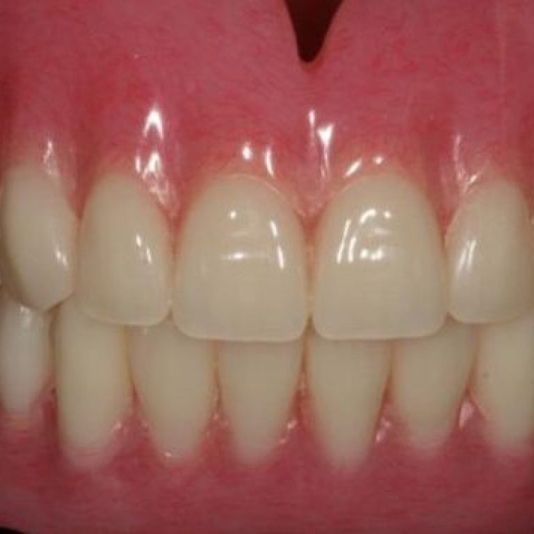 denture1-768x511