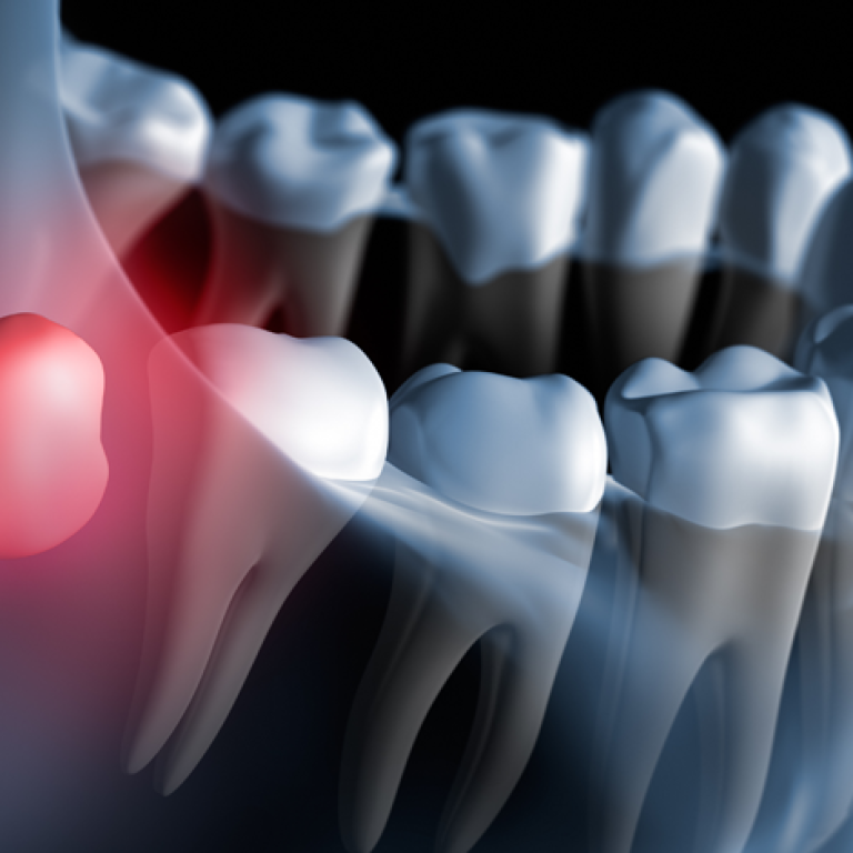 wisdom-tooth-extraction